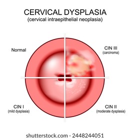 Displasia cervical. Primer plano de un cuello uterino. Cáncer cervical. Neoplasia intraepitelial cervical que se desarrolla desde tejido normal y CIN I con displasia leve hasta carcinoma epidermoide