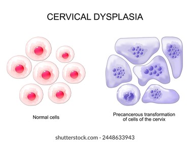 Cervical dysplasia. Close-up of Normal Squamous epithelial cells and Atypical Precancerous transformation of cells of the cervix. Cervical cancer. Cervical intraepithelial neoplasia. Cytology of CIN