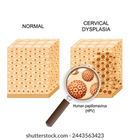 Cervical dysplasia. Cross section of a normal epithelium and Cervical Intraepithelial Neoplasia that caused of Human papillomavirus infection. Close-up of Human papillomavirus. Cervical cancer. Vector