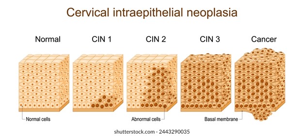 Zervikale Dysplasie. Zervikale intraepitheliale Neoplasie. Epithelquerschnitt. Nahaufnahme einer normalen Plattenepithelzelle und abnormaler Zellen. Zervixkarzinom