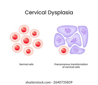 Cervical Dysplasia Normal vs Precancerous Cervical Cells