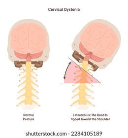 Cervical dystonia. Spasmodic torticollis, inflamatory condition when neck muscles contract involuntarily. Muscle spasms or tremor. Flat vector illustration