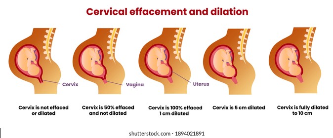 Cervical Effacement And Dilation During Childbirth. 1 Cm, 5 Cm And 10 Cm Dilated. Vector Realistic Medical Illustration