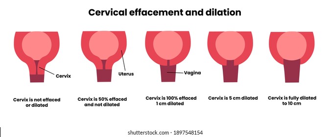 Cervical Effacement And Dilation During Childbirth. 1 Cm, 5 Cm And 10 Cm Dilated. Vector Medical Illustration