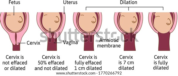 Cervical Effacement Dilation During Delivery Cervix Stock Vector Royalty Free 1770266792