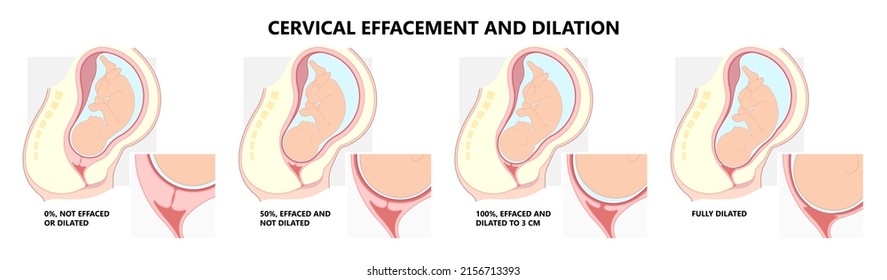 Cervical Effaces And Dilatation Vagina Delivery Labor Fetal Birth Giving Stage Cervix Uterine Left Vertex Mucus Plug Exam Early Baby Thin