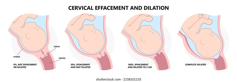 Cervical Effaces And Dilatation Vagina Delivery Labor Fetal Birth Giving Stage Cervix Uterine Left Vertex Mucus Plug Exam Early Baby Thin