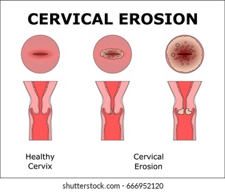 CERVICAL EROSION,color vector illustration
