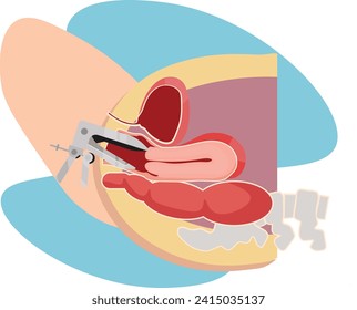 examen cervical utilizando especulum para buscar patología subyacente