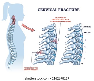 Cervical fracture and human spine and vertebrae damage outline diagram. Labeled educational scheme with backbone spinous process trauma vector illustration. Vertebral compression medical diagnosis.