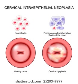 Neoplasia intraepitelial cervical. Displasia cervical. CIN. Lesión precancerosa.  Primer plano de un cuello uterino. Desarrollo de cáncer de célula normal a Transformación precancerosa de células del cuello uterino