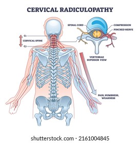 Cervical radiulopathy as painful neck nerve irritation outline diagram. Labeled educational medical compression problem description with skeletal and pinched spinal nerve anatomy vector illustration.