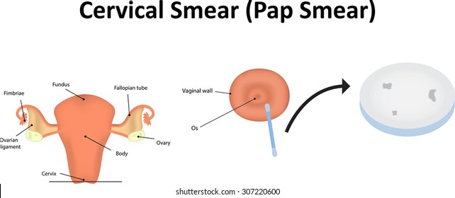 Cervical Smear, Pap Smear