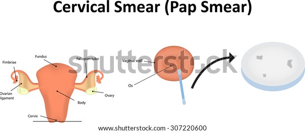 Cervical Smear, Pap\
Smear
