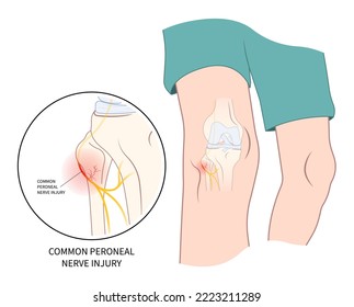 Nervio clavado en la rodilla que causa lesiones traumáticas con síntomas dolorosos