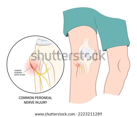 cervical spinal cord test of pain Trauma feet drop palsy leg injury and ankle spine lower damage brain Stroke flex Atrophy lift tibial loss fibular Neck bone common sciatic nerve muscle deep knee Stock photo © 
