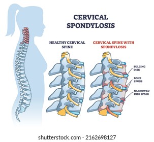 Cervical spondylosis problem compared with healthy spine outline diagram. Labeled educational scheme with human backbone disk bulging, bone spurs and narrowed space explanation vector illustration.