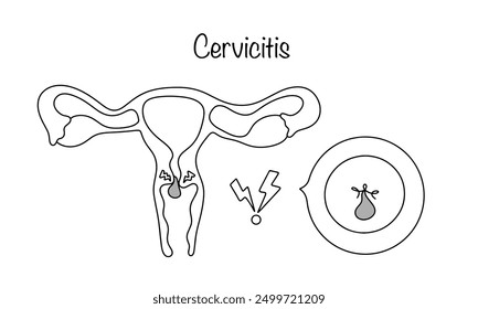 Cervicitis. Gynecological disease, characterized by the presence of an inflammatory process in the cervix. Vector medical illustration.