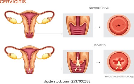 Cervicite é a inflamação do colo do útero, muitas vezes causada por infecções, levando a dor, secreção e sangramento.