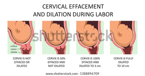 Cervix thinning and\
widening during labor