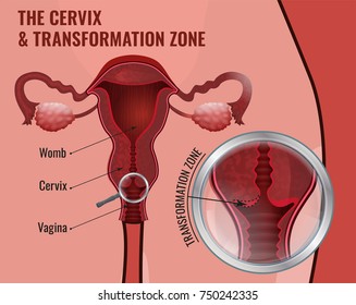 The cervix and transformation zone. Medical infographic. Female reproductive system - uterus, ovary glands and fallopian tubes. Scientific vector illustration in red and pink colors.