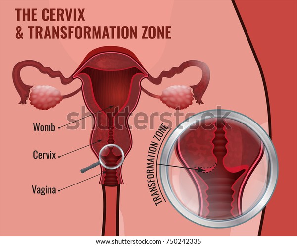 Cervix Transformation Zone Medical Infographic Female Stock Vector Royalty Free 750242335