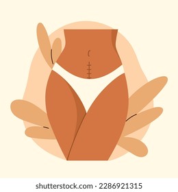 Cesarean scar. Stitches after caesarean section on female belly. C-section, surgical delivery operation concept. Vector illustration in cartoon style. Isolated white background.	
