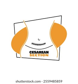 Cesarean Section Day to celebrate on January 14th. Illustration of a cesarean section scar on white background.