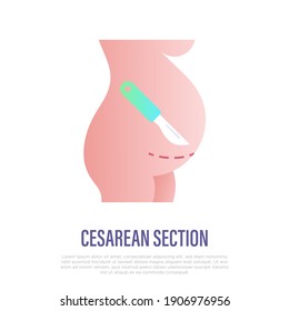 Cesarean section flat gradient icon. Scalpel near belly. Surgical operation for childbirth. Vector illustration.