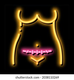 sección cesarean, vector de señal de luz de neón. Icono brillante símbolo de sección cesárea. ilustración de símbolo transparente
