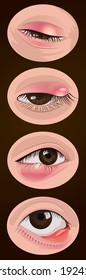 Chalazion and Hordeolum (Stye), Inflammation of the eyelids, Infectious, Medical illustration