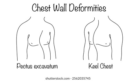 A change in the regular shape of the chest, drawn in simple lines, from front to back. Pectus excavatum and keel chest. Vector illustration.