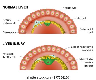 Changes in the hepatic associated with hepatic fibrosis. Normal liver and liver injury.