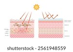 The changes of skin structure damaged by sunlight(before and after comparison). Skin layer vector illustration. Skin anatomy. Epidermis diagram