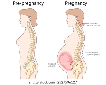 alterações no alinhamento da coluna vertebral desde a pré-gestação até a gestação, lordose cervical, lordose lombar, diagrama de inclinação pélvica desenhado à mão ilustração vetorial esquemática. Ilustração educacional de ciências médicas