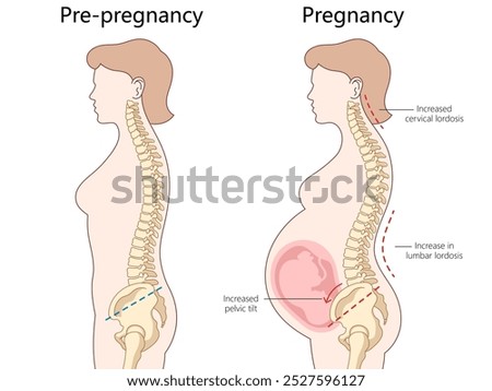 changes in spine alignment from pre-pregnancy to pregnancy, cervical lordosis, lumbar lordosis, pelvic tilt diagram hand drawn schematic vector illustration. Medical science educational illustration