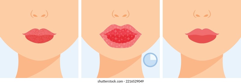 Chapped lips. Hydrogel Patch for Dry and Cracked Lips. Moisturizing Mask. Steps. Before After. Healthy and Soft Lips. Korean Cosmetics. Color Cartoon Style. White background. Vector illustratio