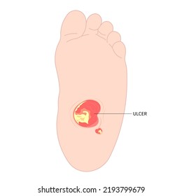 charcot foot painful diabetic gout disease sores leg and Pes cavus arches cavovarus hammer toes