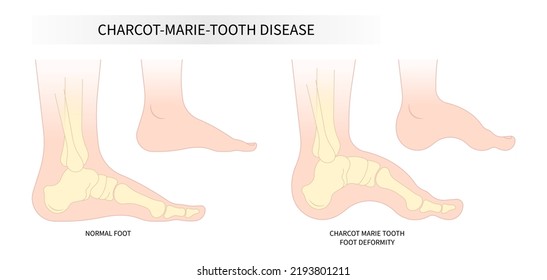 charcot foot painful diabetic gout disease sores leg and Pes cavus arches cavovarus hammer toes