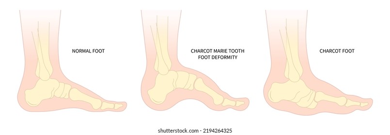 charcot foot painful diabetic gout disease sores leg and Pes cavus arches cavovarus hammer toes