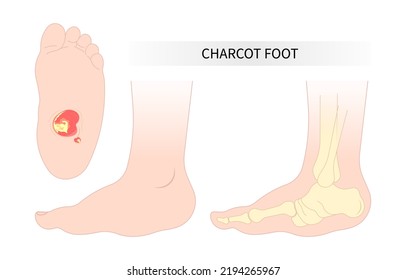 charcot foot painful diabetic gout disease sores leg and Pes cavus arches cavovarus hammer toes