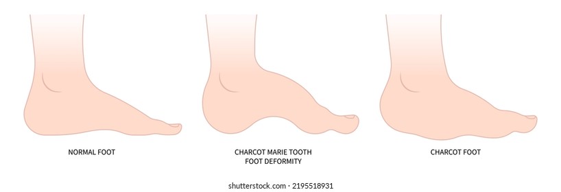 charcot foot painful diabetic gout disease sores leg and Pes cavus arches cavovarus hammer toes