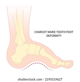 charcot foot painful diabetic gout disease sores leg and Pes cavus arches cavovarus hammer toes