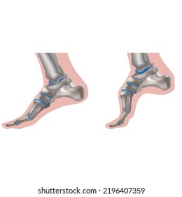 Charcot-Marie-Tooth disease. hereditary disease. Foot of a patient with characteristic symptoms. Hereditary motor-sensory neuropathy. Damage to motor and sensory peripheral nerve fibers.