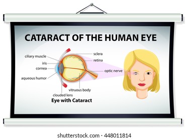Gráfico que muestra la catarata de la ilustración ocular humana