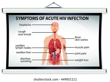 Gráfico que muestra los síntomas de la infección aguda por VIH