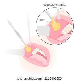 Cheek buccal fat removal and augment excess slim face of Bichat’s procedure