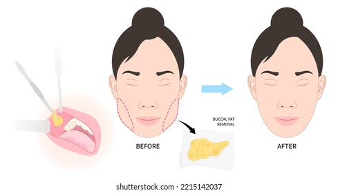 Cheek buccal fat removal and augment excess slim face of Bichat’s procedure