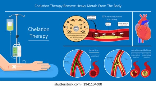 201 Chelation Therapy Images, Stock Photos & Vectors | Shutterstock