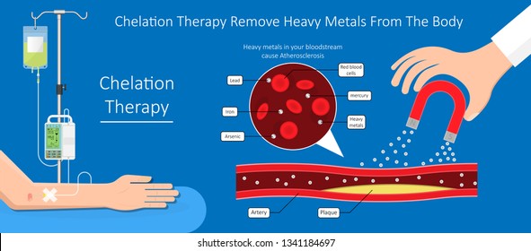 Coronavirus: fin de partie !  - Page 3 Chelation-therapy-lead-mercury-iron-260nw-1341184697